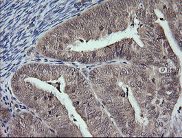 MAP2K3 / MEK3 / MKK3 Antibody - IHC of paraffin-embedded Adenocarcinoma of Human endometrium tissue using anti-MAP2K3 mouse monoclonal antibody.