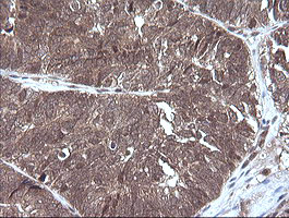 MAP2K3 / MEK3 / MKK3 Antibody - IHC of paraffin-embedded Adenocarcinoma of Human ovary tissue using anti-MAP2K3 mouse monoclonal antibody. (Heat-induced epitope retrieval by 10mM citric buffer, pH6.0, 120°C for 3min).
