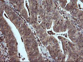 MAP2K3 / MEK3 / MKK3 Antibody - IHC of paraffin-embedded Adenocarcinoma of Human endometrium tissue using anti-MAP2K3 mouse monoclonal antibody.