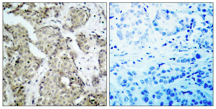 MAP2K3 / MEK3 / MKK3 Antibody - Immunohistochemistry analysis of paraffin-embedded human breast carcinoma, using MKK3 (Phospho-Ser189) Antibody. The picture on the right is blocked with the phospho peptide.