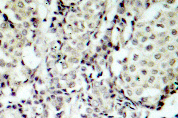 MAP2K3 / MEK3 / MKK3 Antibody - IHC of MKK3 (S183) pAb in paraffin-embedded human breast carcinoma tissue.