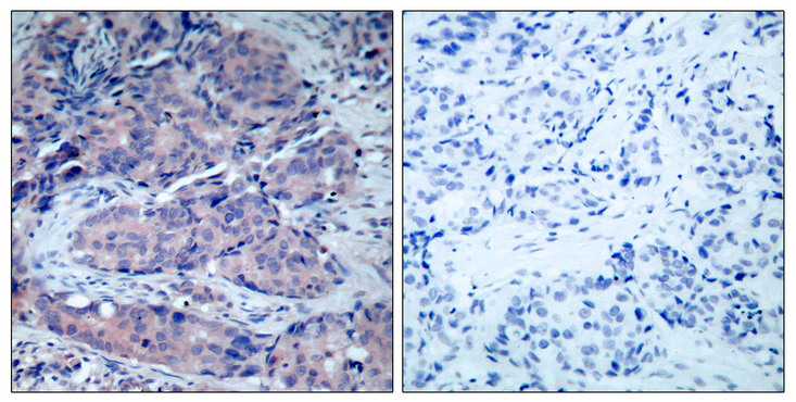 MAP2K4 / MKK4 Antibody - Immunohistochemistry analysis of paraffin-embedded human breast carcinoma tissue, using SEK1/MKK4 Antibody. The picture on the right is blocked with the synthesized peptide.