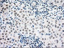 MAP2K4 / MKK4 Antibody - IHC of paraffin-embedded Adenocarcinoma of breast tissue using anti-MAP2K4 mouse monoclonal antibody. (Dilution 1:50).