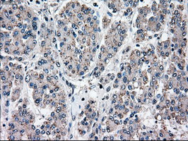MAP2K4 / MKK4 Antibody - IHC of paraffin-embedded Carcinoma of liver tissue using anti-MAP2K4 mouse monoclonal antibody. (Dilution 1:50).