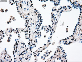 MAP2K4 / MKK4 Antibody - IHC of paraffin-embedded Carcinoma of lung tissue using anti-MAP2K4 mouse monoclonal antibody. (Dilution 1:50).
