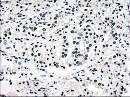MAP2K4 / MKK4 Antibody - IHC of paraffin-embedded Carcinoma of prostate tissue using anti-MAP2K4 mouse monoclonal antibody. (Dilution 1:50).