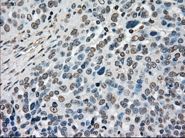 MAP2K4 / MKK4 Antibody - Immunohistochemical staining of paraffin-embedded Adenocarcinoma of ovary tissue using anti-MAP2K4 mouse monoclonal antibody. (Dilution 1:50).