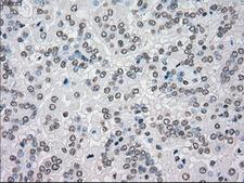 MAP2K4 / MKK4 Antibody - Immunohistochemical staining of paraffin-embedded Carcinoma of kidney tissue using anti-MAP2K4 mouse monoclonal antibody. (Dilution 1:50).