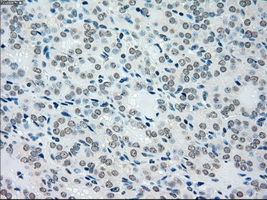 MAP2K4 / MKK4 Antibody - Immunohistochemical staining of paraffin-embedded Carcinoma of thyroid tissue using anti-MAP2K4 mouse monoclonal antibody. (Dilution 1:50).