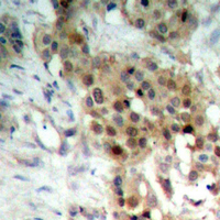 MAP2K4 / MKK4 Antibody - Immunohistochemical analysis of MKK4 staining in human breast cancer formalin fixed paraffin embedded tissue section. The section was pre-treated using heat mediated antigen retrieval with sodium citrate buffer (pH 6.0). The section was then incubated with the antibody at room temperature and detected using an HRP conjugated compact polymer system. DAB was used as the chromogen. The section was then counterstained with hematoxylin and mounted with DPX.