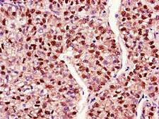 MAP2K4 / MKK4 Antibody - Immunohistochemistry of paraffin-embedded human liver cancer using MAP2K4 Antibody at dilution of 1:100