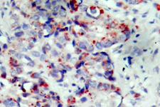 MAP2K4 / MKK4 Antibody - IHC of p-SEK1/MKK4 (S80) pAb in paraffin-embedded human breast carcinoma tissue.