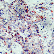 MAP2K4 / MKK4 Antibody - Immunohistochemical analysis of paraffin-embedded human breast carcinoma tissue.