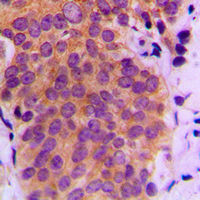 MAP2K4 / MKK4 Antibody - Immunohistochemical analysis of MKK4 (pS80) staining in human breast cancer formalin fixed paraffin embedded tissue section. The section was pre-treated using heat mediated antigen retrieval with sodium citrate buffer (pH 6.0). The section was then incubated with the antibody at room temperature and detected using an HRP conjugated compact polymer system. DAB was used as the chromogen. The section was then counterstained with hematoxylin and mounted with DPX.