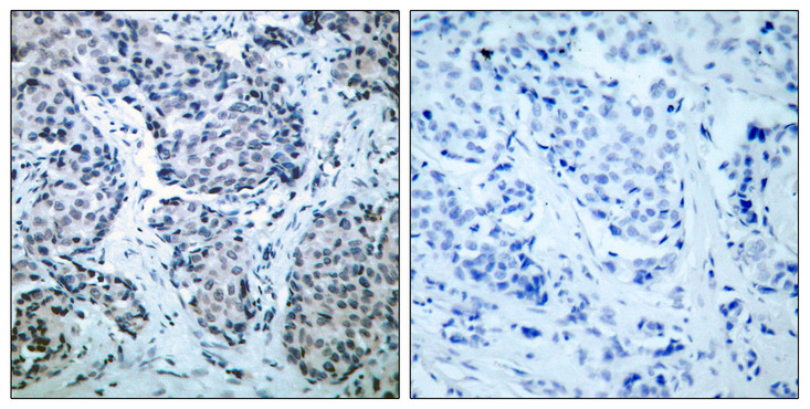 MAP2K4 / MKK4 Antibody - Immunohistochemistry analysis of paraffin-embedded human breast carcinoma, using SEK1/MKK4 (Phospho-Thr261) Antibody. The picture on the right is blocked with the phospho peptide.