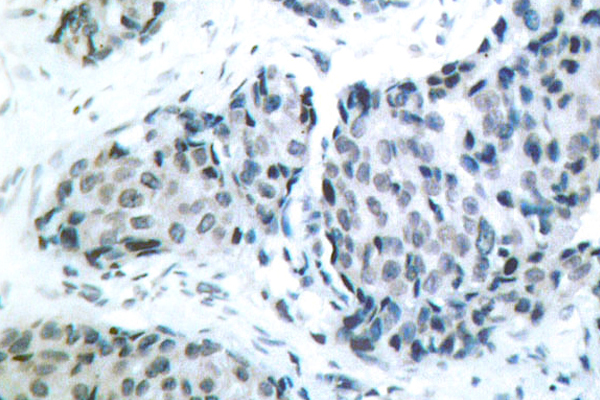 MAP2K4 / MKK4 Antibody - IHC of p-SEK1 /MKK4 (T261) pAb in paraffin-embedded human breast carcinoma tissue.