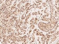 MAP2K4 / MKK4 Antibody - Immunochemical staining of human MAP2K4 in human breast carcinoma with rabbit polyclonal antibody at 1:1000 dilution, formalin-fixed paraffin embedded sections.