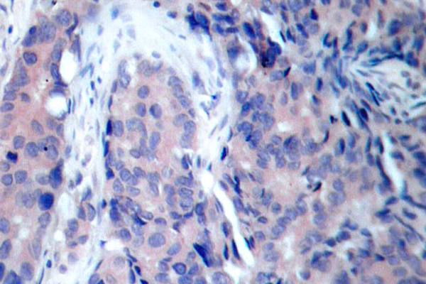 MAP2K4 / MKK4 Antibody - IHC of SEK1/MKK4 (V255) pAb in paraffin-embedded human breast carcinoma tissue.
