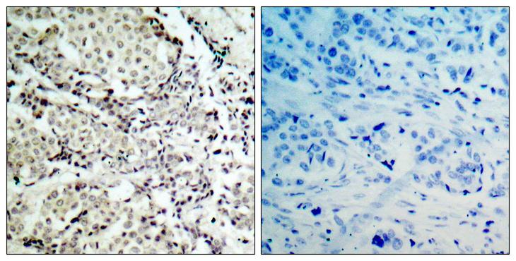 MAP2K6 / MEK6 / MKK6 Antibody - Immunohistochemistry analysis of paraffin-embedded human breast carcinoma tissue, using MKK6 Antibody. The picture on the right is blocked with the synthesized peptide.