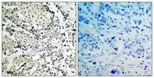 MAP2K6 / MEK6 / MKK6 Antibody - Immunohistochemistry analysis of paraffin-embedded human breast carcinoma tissue, using MKK6 Antibody. The picture on the right is blocked with the synthesized peptide.