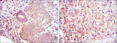 MAP2K6 / MEK6 / MKK6 Antibody - IHC of paraffin-embedded ovarian cancer (left) and kidney cancer (right) using MAP2K6 mouse monoclonal antibody with DAB staining.