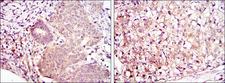 MAP2K6 / MEK6 / MKK6 Antibody - IHC of paraffin-embedded ovarian cancer (left) and kidney cancer (right) using MAP2K6 mouse monoclonal antibody with DAB staining.