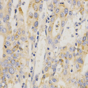 MAP2K6 / MEK6 / MKK6 Antibody - Immunohistochemistry of paraffin-embedded human stomach cancer tissue.