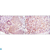 MAP2K6 / MEK6 / MKK6 Antibody - Immunohistochemistry (IHC) analysis of paraffin-embedded ovarian cancer (left) and kidney cancer (right) with DAB staining using MEK-6 Monoclonal Antibody.