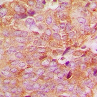 MAP2K6 / MEK6 / MKK6 Antibody - Immunohistochemical analysis of MKK6 staining in human breast cancer formalin fixed paraffin embedded tissue section. The section was pre-treated using heat mediated antigen retrieval with sodium citrate buffer (pH 6.0). The section was then incubated with the antibody at room temperature and detected with HRP and DAB as chromogen. The section was then counterstained with hematoxylin and mounted with DPX.