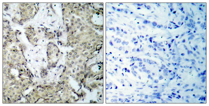 MAP2K6 / MEK6 / MKK6 Antibody - Immunohistochemistry analysis of paraffin-embedded human breast carcinoma, using MKK6 (Phospho-Ser207) Antibody. The picture on the right is blocked with the phospho peptide.