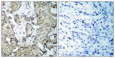 MAP2K6 / MEK6 / MKK6 Antibody - Immunohistochemistry analysis of paraffin-embedded human breast carcinoma, using MKK6 (Phospho-Ser207) Antibody. The picture on the right is blocked with the phospho peptide.