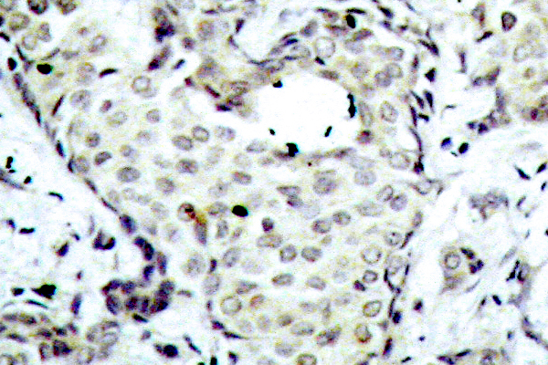 MAP2K6 / MEK6 / MKK6 Antibody - IHC of MKK6 (S201) pAb in paraffin-embedded human breast carcinoma tissue.