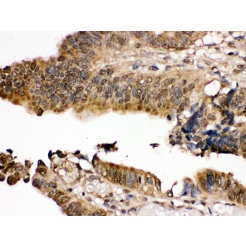 MAP2K7 / MEK7 Antibody - MEK7 antibody IHC-paraffin. IHC(P): Human Intestinal Cancer Tissue.
