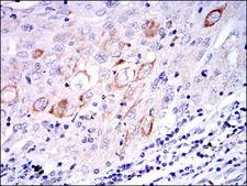MAP2K7 / MEK7 Antibody - IHC of paraffin-embedded lung cancer tissues using MAP2K7 mouse monoclonal antibody with DAB staining.