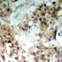 MAP2K7 / MEK7 Antibody - Immunohistochemical analysis of MKK7 (pS271) staining in human breast cancer formalin fixed paraffin embedded tissue section. The section was pre-treated using heat mediated antigen retrieval with sodium citrate buffer (pH 6.0). The section was then incubated with the antibody at room temperature and detected using an HRP conjugated compact polymer system. DAB was used as the chromogen. The section was then counterstained with hematoxylin and mounted with DPX.