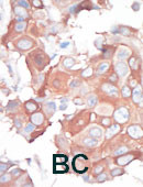 MAP3K1 / MEKK1 Antibody - Formalin-fixed and paraffin-embedded human cancer tissue reacted with the primary antibody, which was peroxidase-conjugated to the secondary antibody, followed by AEC staining. This data demonstrates the use of this antibody for immunohistochemistry; clinical relevance has not been evaluated. BC = breast carcinoma; HC = hepatocarcinoma.