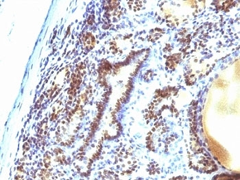MAP3K1 / MEKK1 Antibody - Formalin-fixed, paraffin-embedded human thyroid carcinoma stained with MAP3K1 antibody (2F6).  This image was taken for the unmodified form of this product. Other forms have not been tested.