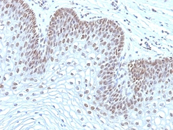 MAP3K1 / MEKK1 Antibody - Formalin-fixed, paraffin-embedded human cervical carcinoma stained with MAP3K1 antibody (2F6).  This image was taken for the unmodified form of this product. Other forms have not been tested.