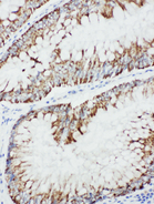 MAP3K1 / MEKK1 Antibody - MAP3K1 / MEKK1 antibody. IHC(P): Human Intestinal Cancer Tissue.