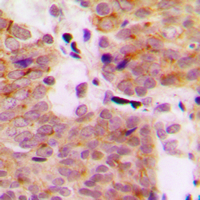 MAP3K1 / MEKK1 Antibody - Immunohistochemical analysis of MEKK1 (pT1402) staining in human breast cancer formalin fixed paraffin embedded tissue section. The section was pre-treated using heat mediated antigen retrieval with sodium citrate buffer (pH 6.0). The section was then incubated with the antibody at room temperature and detected using an HRP conjugated compact polymer system. DAB was used as the chromogen. The section was then counterstained with hematoxylin and mounted with DPX.