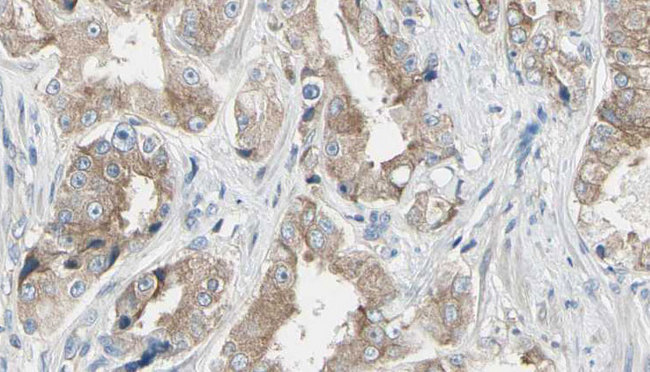 MAP3K1 / MEKK1 Antibody - 1:100 staining human prostate tissue by IHC-P. The sample was formaldehyde fixed and a heat mediated antigen retrieval step in citrate buffer was performed. The sample was then blocked and incubated with the antibody for 1.5 hours at 22°C. An HRP conjugated goat anti-rabbit antibody was used as the secondary.
