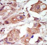 MAP3K10 / MLK2 Antibody - Formalin-fixed and paraffin-embedded human cancer tissue reacted with the primary antibody, which was peroxidase-conjugated to the secondary antibody, followed by DAB staining. This data demonstrates the use of this antibody for immunohistochemistry; clinical relevance has not been evaluated. BC = breast carcinoma; HC = hepatocarcinoma.
