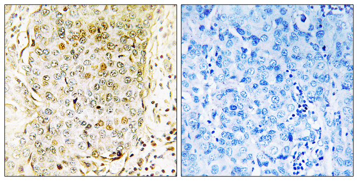 MAP3K11 / MLK3 Antibody - Immunohistochemistry analysis of paraffin-embedded human breast carcinoma tissue, using MLK3 Antibody. The picture on the right is blocked with the synthesized peptide.