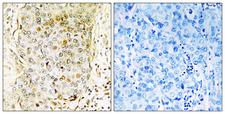 MAP3K11 / MLK3 Antibody - Peptide - + Immunohistochemistry analysis of paraffin-embedded human breast carcinoma tissue using MLK3 antibody.