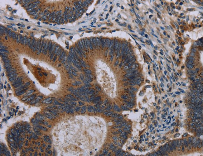 MAP3K11 / MLK3 Antibody - Immunohistochemistry of paraffin-embedded Human colon cancer using MAP3K11 Polyclonal Antibody at dilution of 1:40.