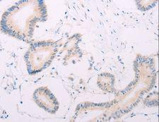 MAP3K12 Antibody - Immunohistochemistry of paraffin-embedded Human thyroid cancer using MAP3K12 Polyclonal Antibody at dilution of 1:30.