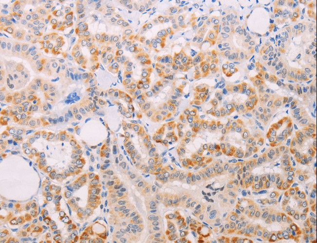 MAP3K12 Antibody - Immunohistochemistry of paraffin-embedded Human thyroid cancer using MAP3K12 Polyclonal Antibody at dilution of 1:30.