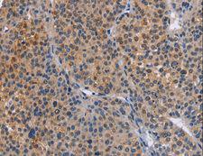 MAP3K13 / LZK Antibody - Immunohistochemistry of paraffin-embedded Human cervical cancer using MAP3K13 Polyclonal Antibody at dilution of 1:40.