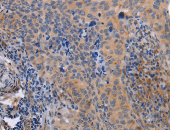 MAP3K13 / LZK Antibody - Immunohistochemistry of paraffin-embedded Human cervical cancer using MAP3K13 Polyclonal Antibody at dilution of 1:40.