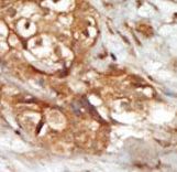 MAP3K14 Antibody - Formalin-fixed and paraffin-embedded human cancer tissue reacted with the primary antibody, which was peroxidase-conjugated to the secondary antibody, followed by AEC staining. This data demonstrates the use of this antibody for immunohistochemistry; clinical relevance has not been evaluated. BC = breast carcinoma; HC = hepatocarcinoma.